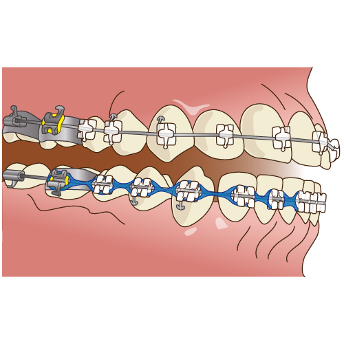 治療装置の装着